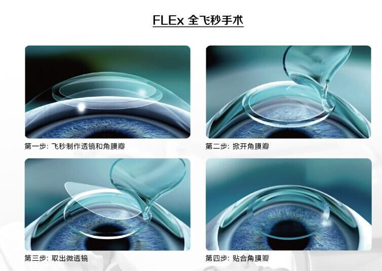 蔡司全飛秒、蔡司半飛秒近視手術(shù)與蔡司全飛秒flex手術(shù)
