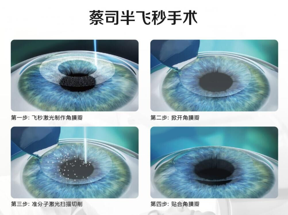 蔡司全飛秒、蔡司半飛秒近視手術(shù)與蔡司全飛秒flex手術(shù)