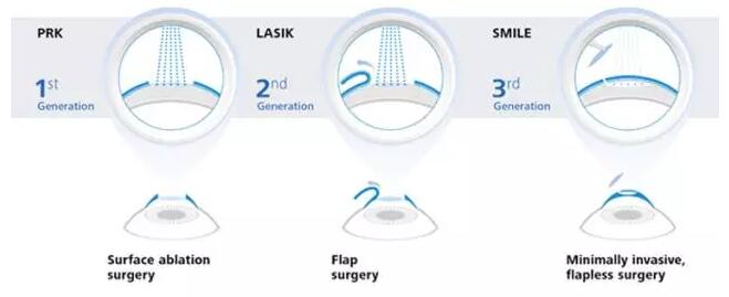 德國蔡司全飛秒SMILE通過美國FDA認證！