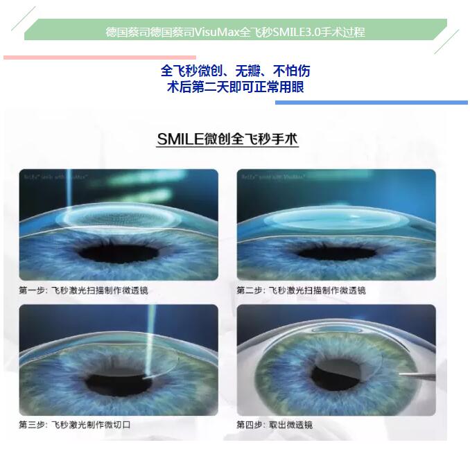 德國蔡司全飛秒SMILE通過美國FDA認證！