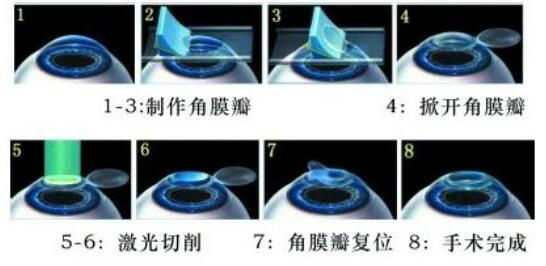 準(zhǔn)分子激光手術(shù)到底是怎么治 愈你的眼睛的？