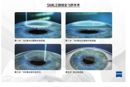 準(zhǔn)分子激光手術(shù)到底是怎么治 愈你的眼睛的？