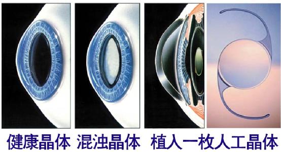超聲乳化手術(shù)白內(nèi)障危險(xiǎn)嗎？