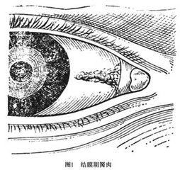 黑眼睛前面多長出一塊白肉怎么辦？