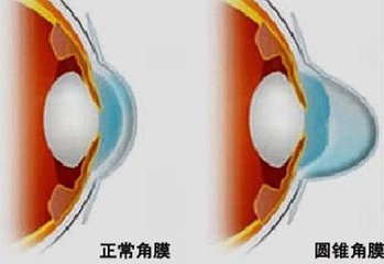 圓錐角膜，哪種角膜移植術(shù)好？