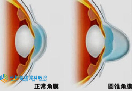 圓錐角膜怎樣？