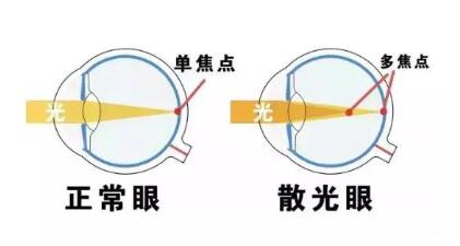 近視和散光，手術能同時矯正嗎？