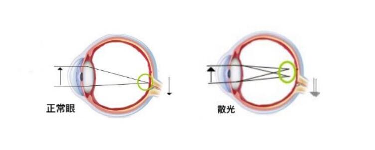 高度散光加近視可以做手術(shù)嗎？